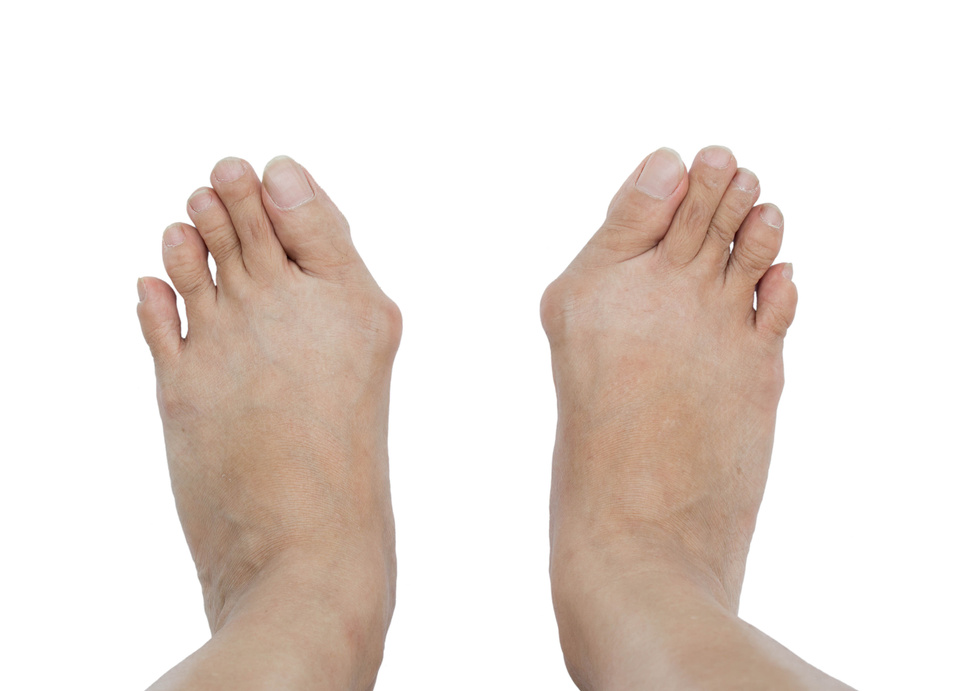 Hallux valgus, bunion in foot.